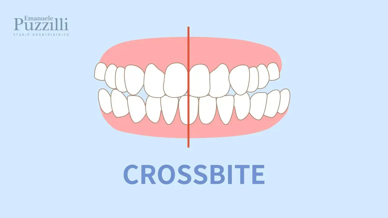 Illustrazione di un morso inverso (crossbite), dove i denti superiori si posizionano all'interno di quelli inferiori.