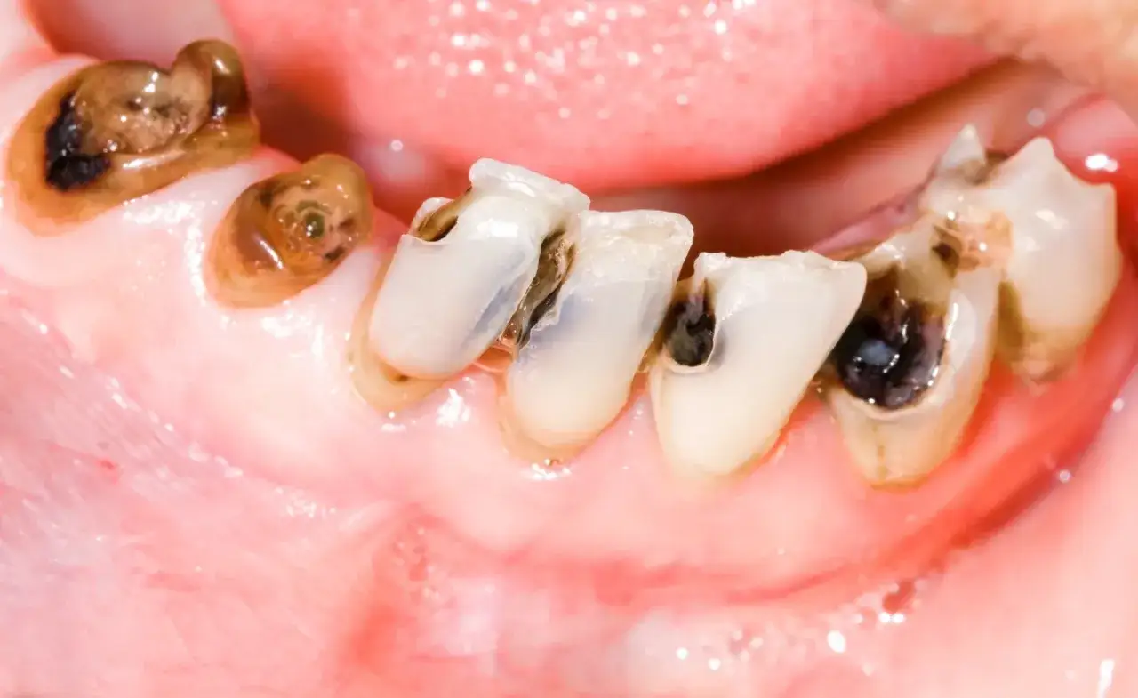 Denti cariati e rovinati. Impossibile curare una carie a casa, serve un dentista.