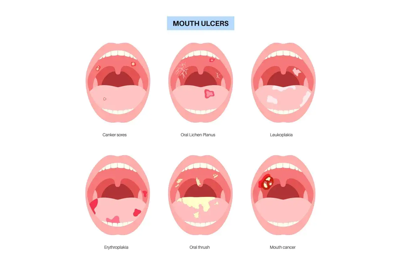 Illustrazione di diverse condizioni della bocca, tra cui afte bucali, lichen planus orale, leucoplachia, eritroplachia, mughetto orale e cancro orale.