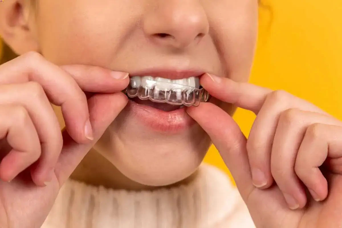 Dita che posizionano un apparecchio trasparente, un attachment invisalign, per un sorriso perfetto.