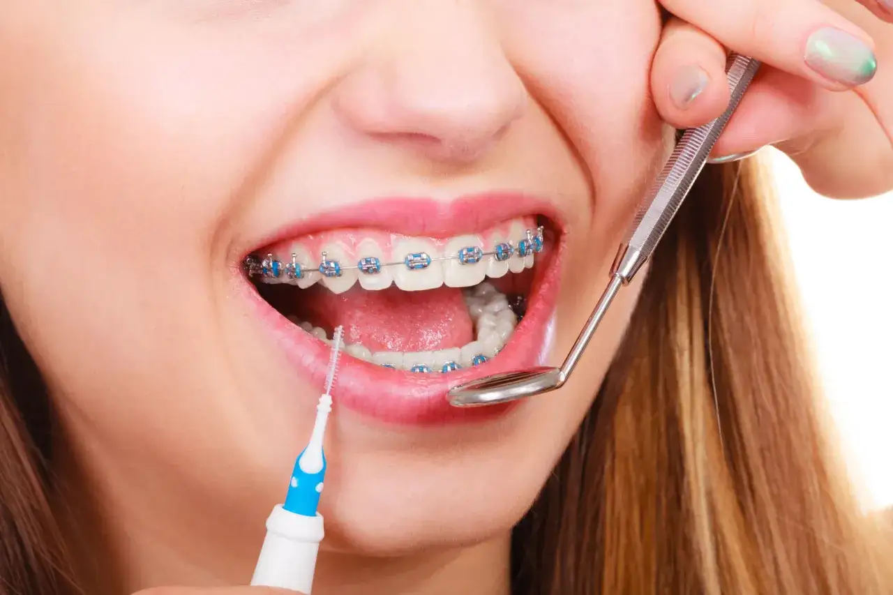 Bocca con apparecchio ortodontico, pulizia interdentale. La frequenza con cui si stringe l'apparecchio dipende dal parere del dentista.