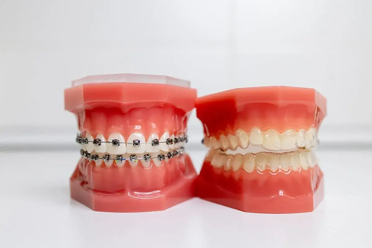 Modelli di denti con apparecchi tradizionali e invisibili. Valutare il costo apparecchio denti per un sorriso perfetto.