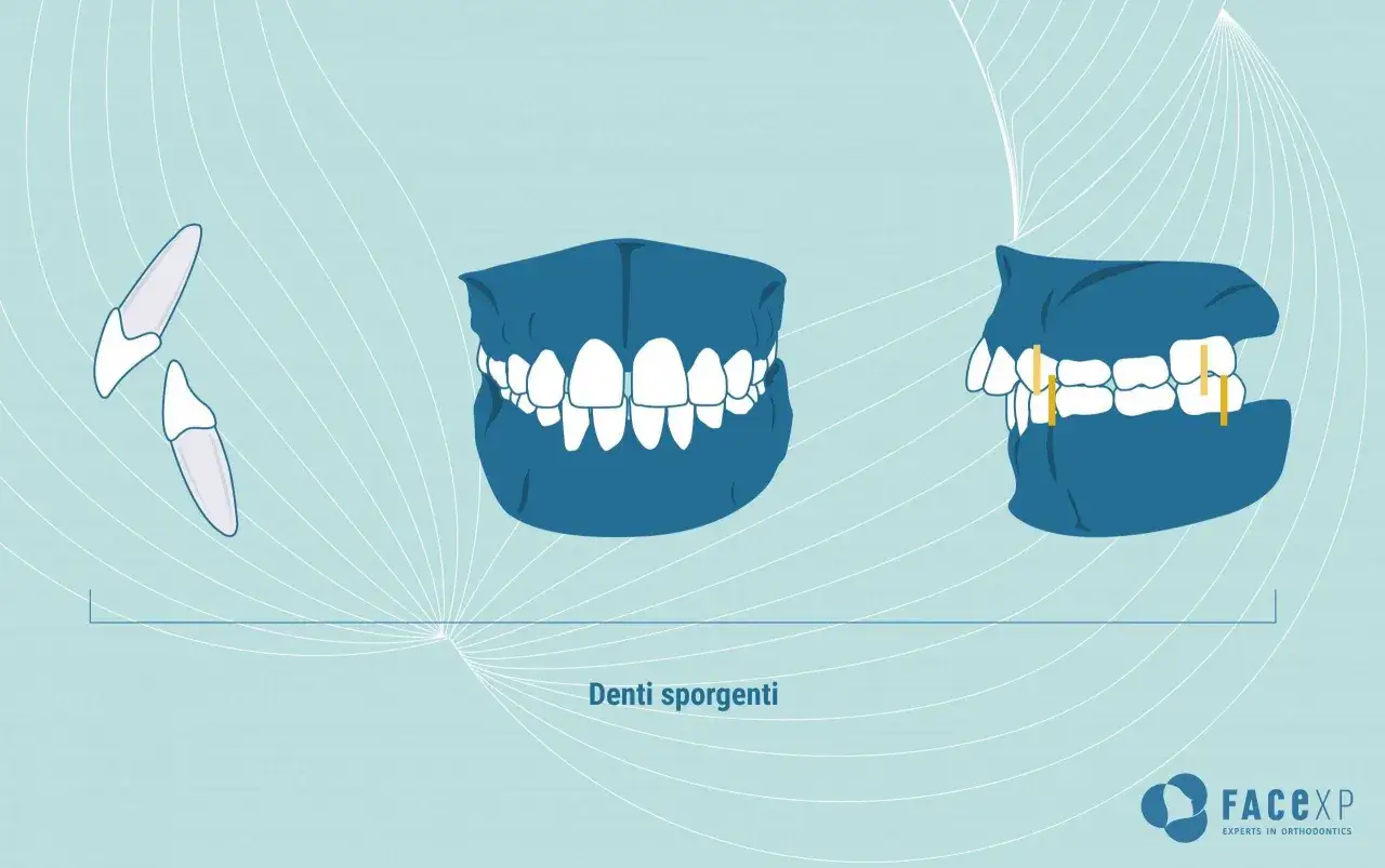 Illustrazione di denti sporgenti e la loro correzione. Non esistono rimedi fai da te per i denti sporgenti, ma soluzioni ortodontiche efficaci.