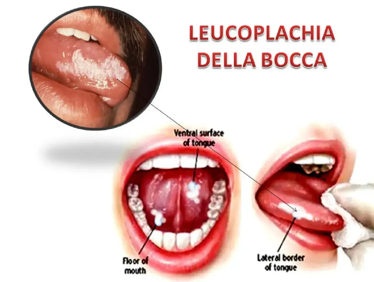 Leucoplachia della bocca: lesioni biancastre sulla lingua e nel cavo orale, come illustrato.