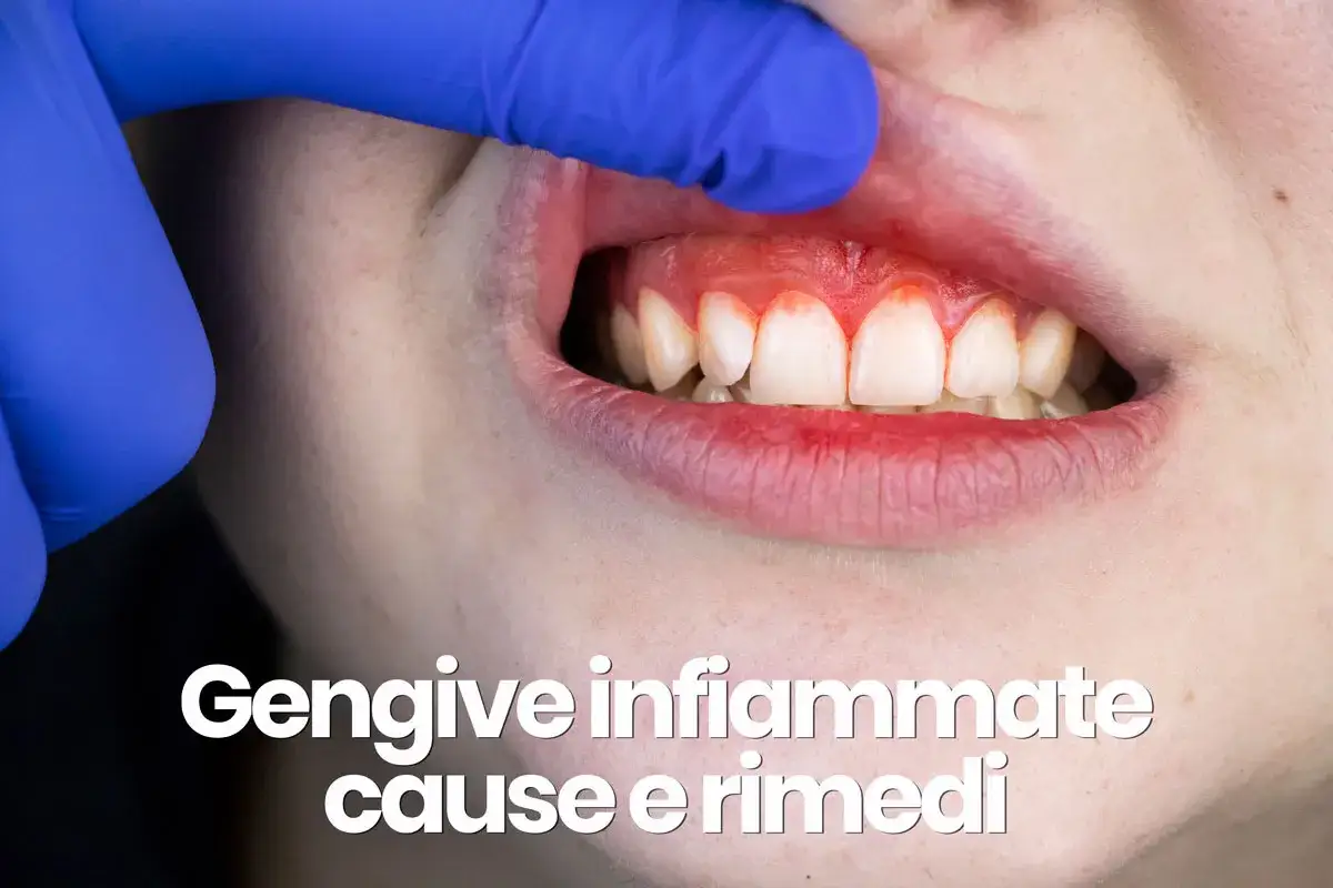 Dente con clorexidina per gengive infiammate. Un dito guantato solleva il labbro mostrando il rossore e l'infiammazione.