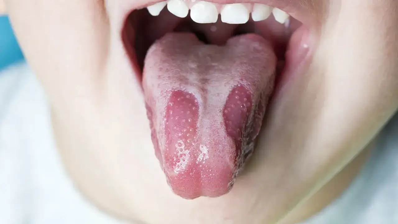 Lingua con macchie rosse e bianche, forse dovute a irritazione o infezione.