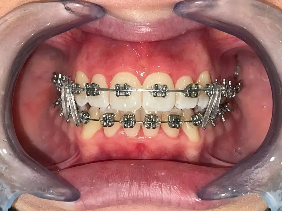 Apparecchio denti con attacchi a forma di stelline, per un sorriso scintillante.