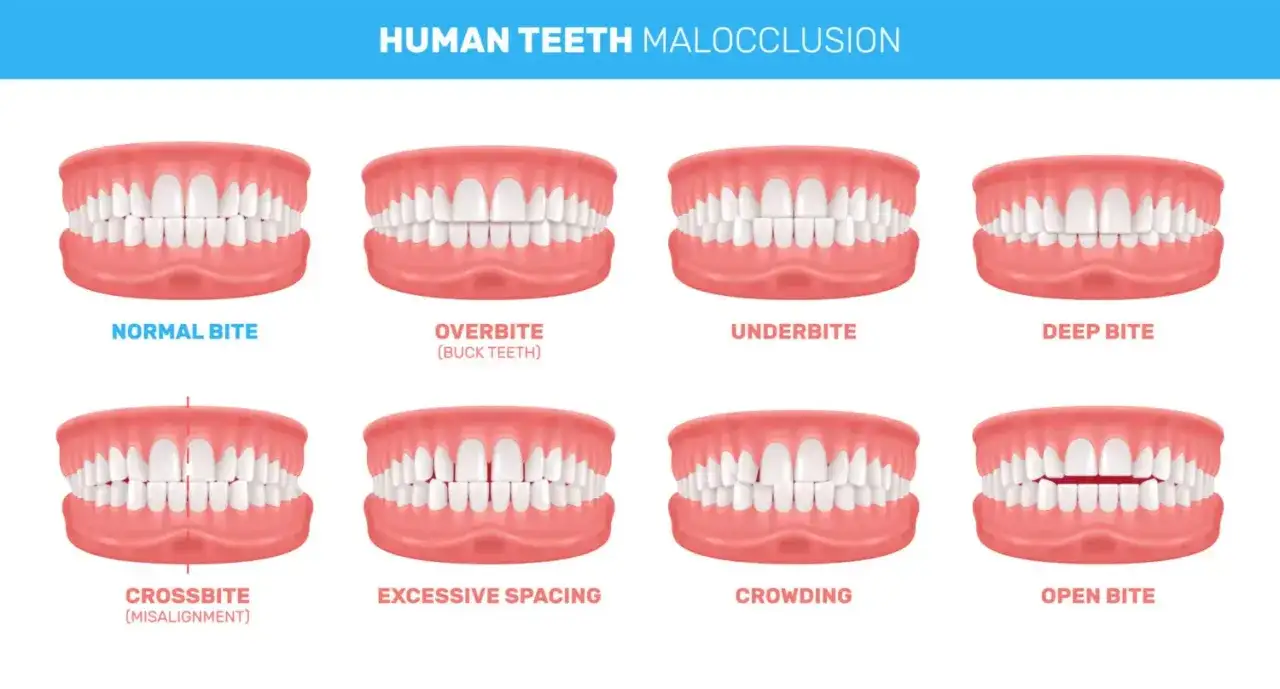 Illustrazione di diverse malocclusioni dentali: morso aperto, profondo, incrociato, affollamento, ecc. I sintomi di malocclusione dentale variano.