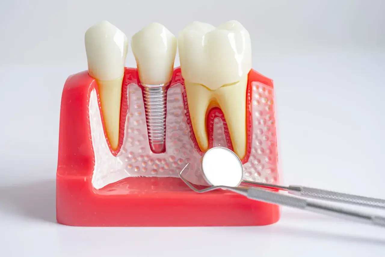 Modello dentale con impianto e strumenti. Si può mettere l'apparecchio avendo degli impianti, una soluzione moderna per un sorriso perfetto.