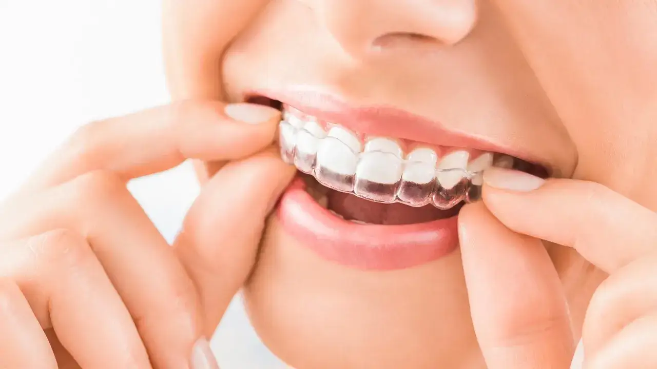 Dita che sistemano un invisalign indossato, mostrando un sorriso curato e discreto.