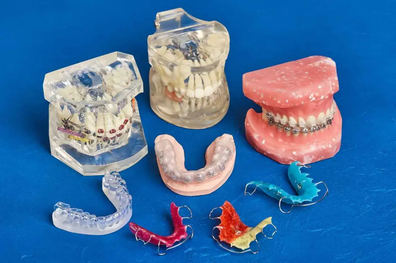 Modelli di denti con apparecchi ortodontici e apparecchi di contenzione. Anche se l'apparecchio rende difficile mangiare le patatine, questi modelli mostrano le opzioni per un sorriso perfetto.
