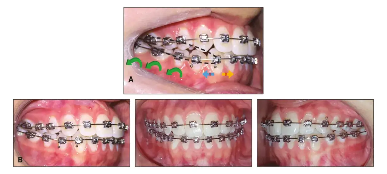 Dettaglio dell'apparecchio ortodontico con elastici intermascellari che guidano il movimento dei denti.