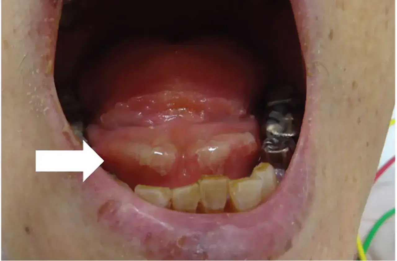 Freccia bianca indica infiammazione sotto la lingua, con gengive arrossate e denti usurati.
