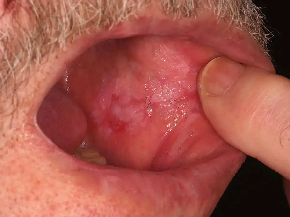Interno guancia con aree biancastre e arrossate, indicative di morsicatio buccarum. Dito che solleva la guancia.