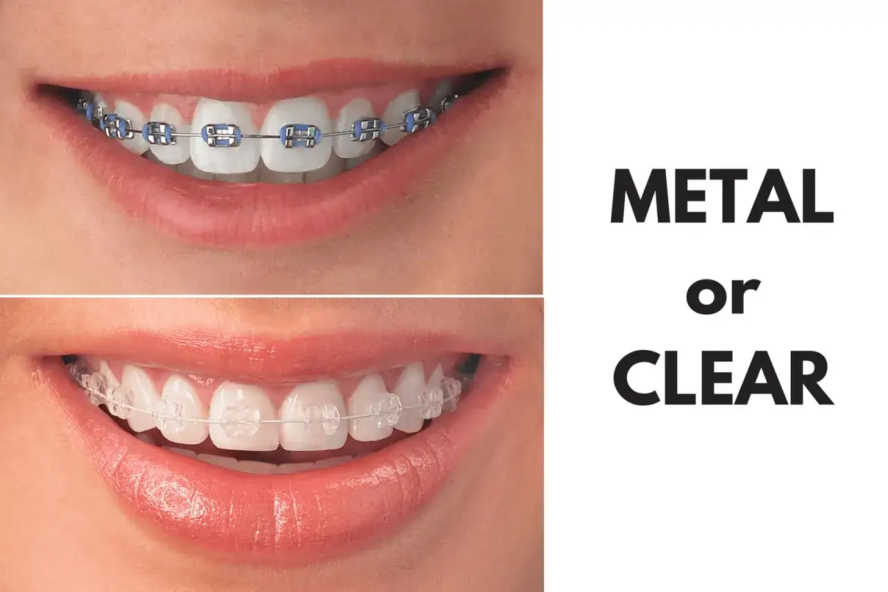 Sorrisi di adulti con denti storti: apparecchi metallici blu o trasparenti.