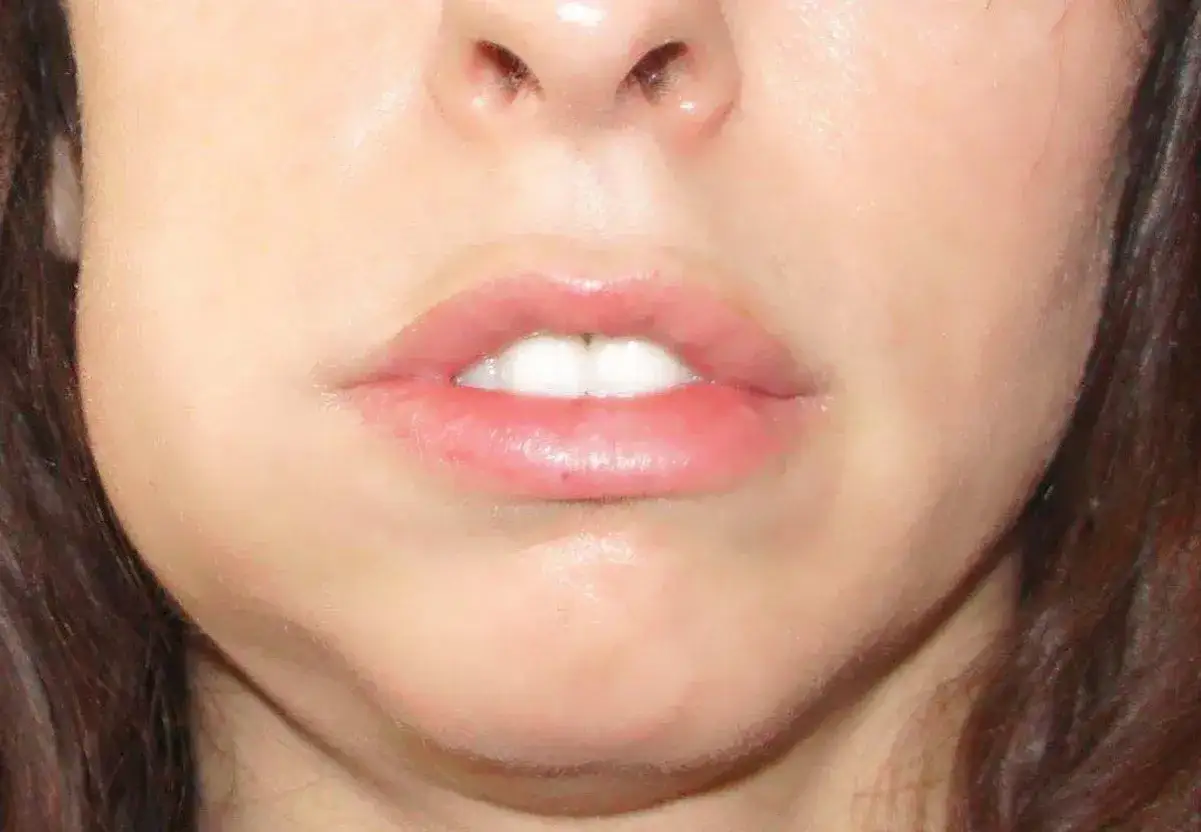 Guancia gonfia dopo anestesia dal dentista, labbra rosa e denti bianchi visibili.