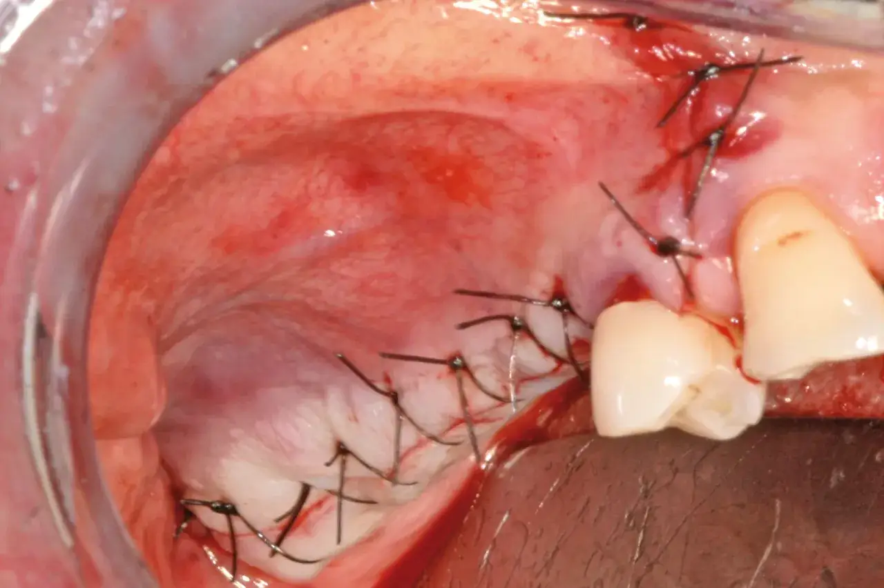 Bocca con gengive suturate dopo un intervento di antrostomia mascellare. Si notano i punti metallici e il tessuto sanguinolento.