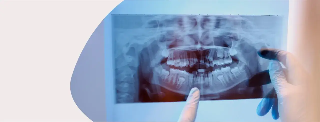 Dente da latte in radiografia, esaminato con guanti bianchi. Il principio Alara guida la valutazione.