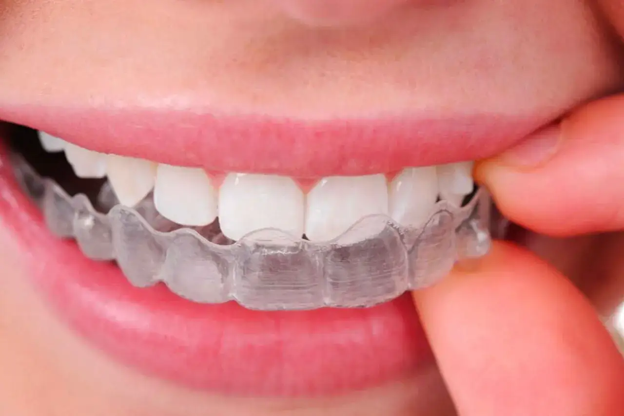 Denti allineati con Invisalign, indossati 20 ore al giorno per un sorriso perfetto.