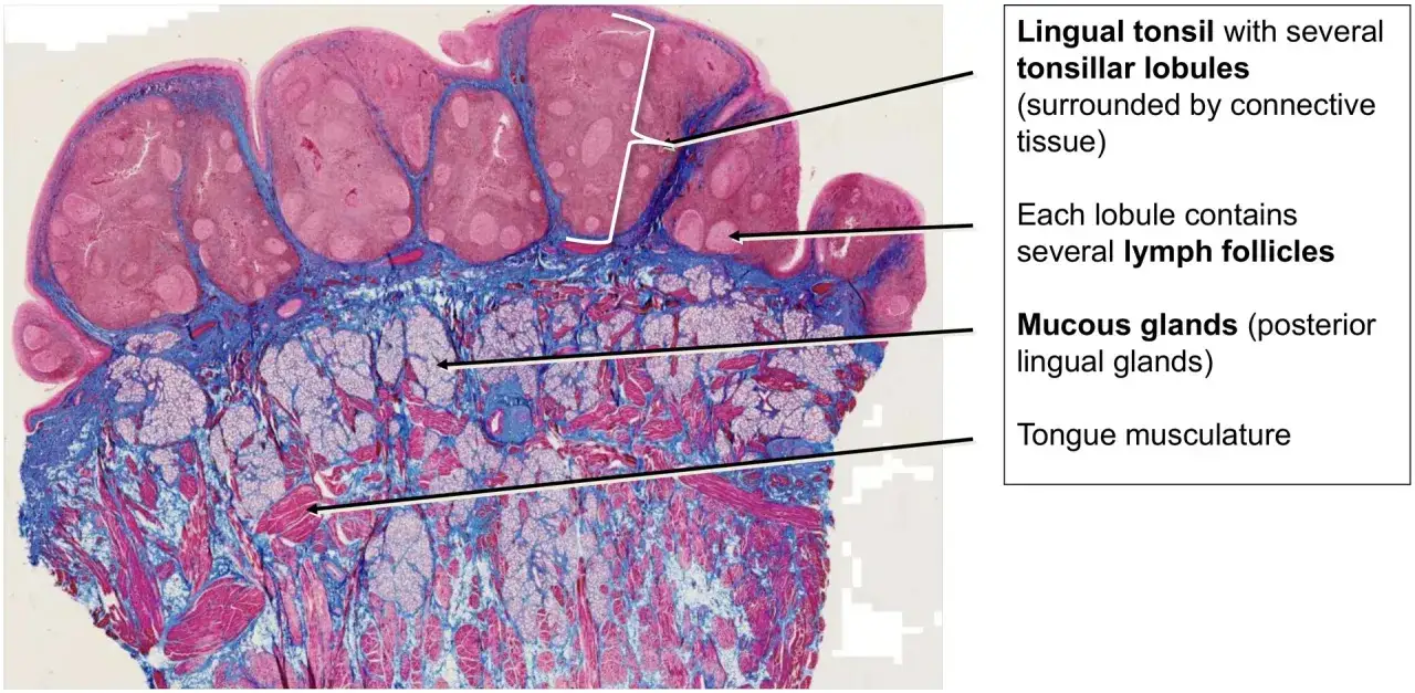 Sezione istologica della lingua: protuberanze in fondo alla lingua (tonsille linguali) con lobuli tonsillari e follicoli linfatici, ghiandole mucose e muscolatura linguale.