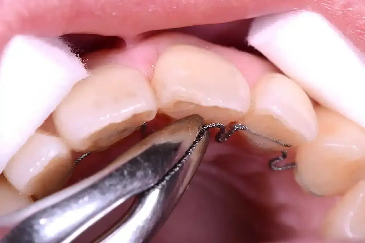 Chiusura di un diastema denti con apparecchio ortodontico. Pinze dentali lavorano sui fili per avvicinare i denti.