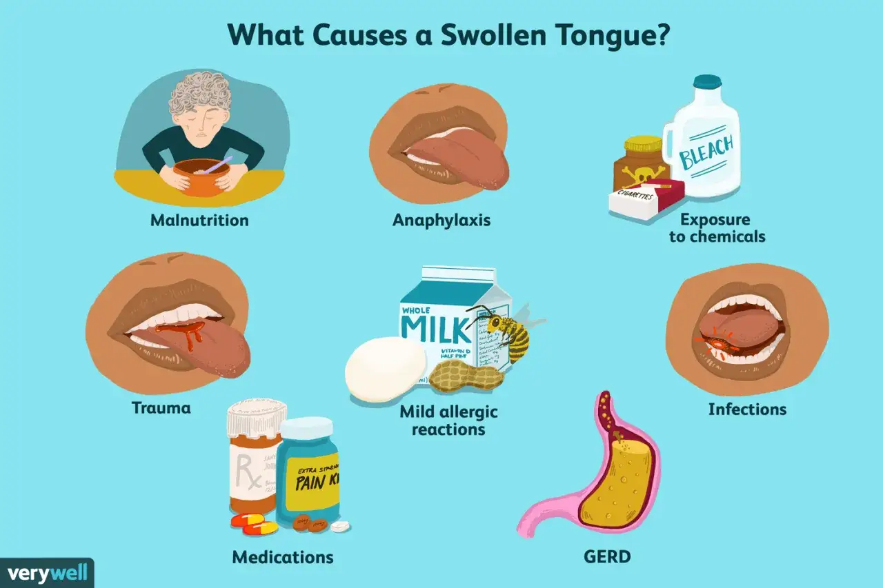 Lingua gonfia stress: cause come malnutrizione, allergie, infezioni, traumi, farmaci, GERD, anafilassi, esposizione a sostanze chimiche.
