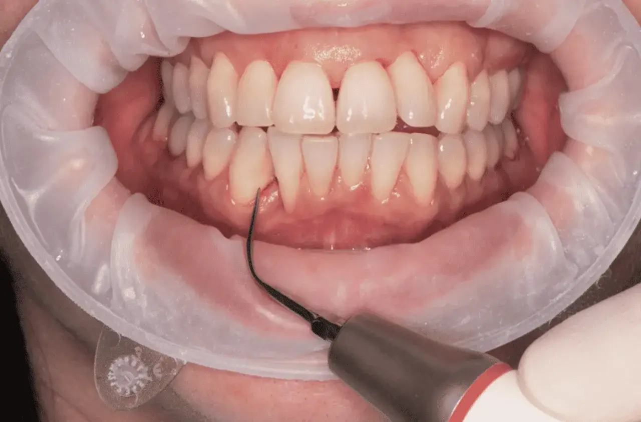 Denti bianchi e sani durante la pulizia denti con uno strumento odontoiatrico.