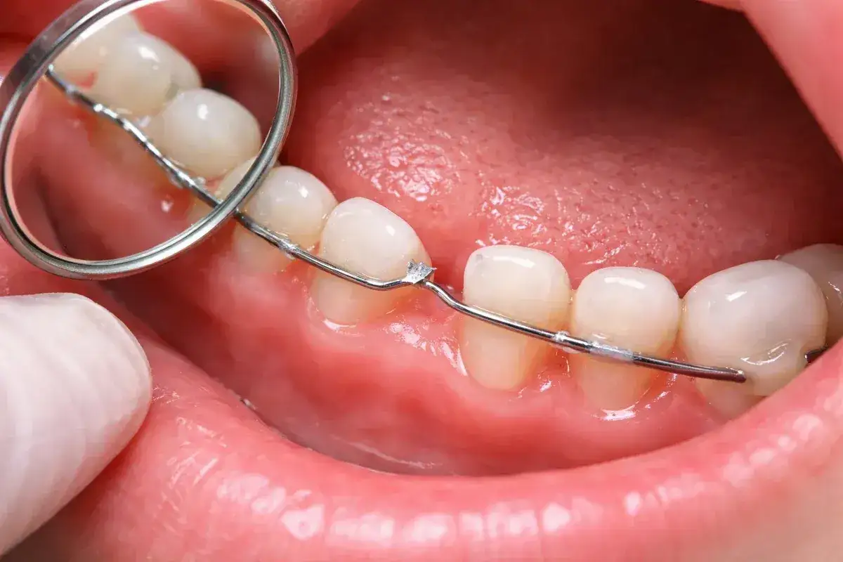 Primo piano di denti con apparecchio ortodontico. Un dentista controlla il filo, fondamentale per capire ogni quanto si cambia il filo dell'apparecchio.