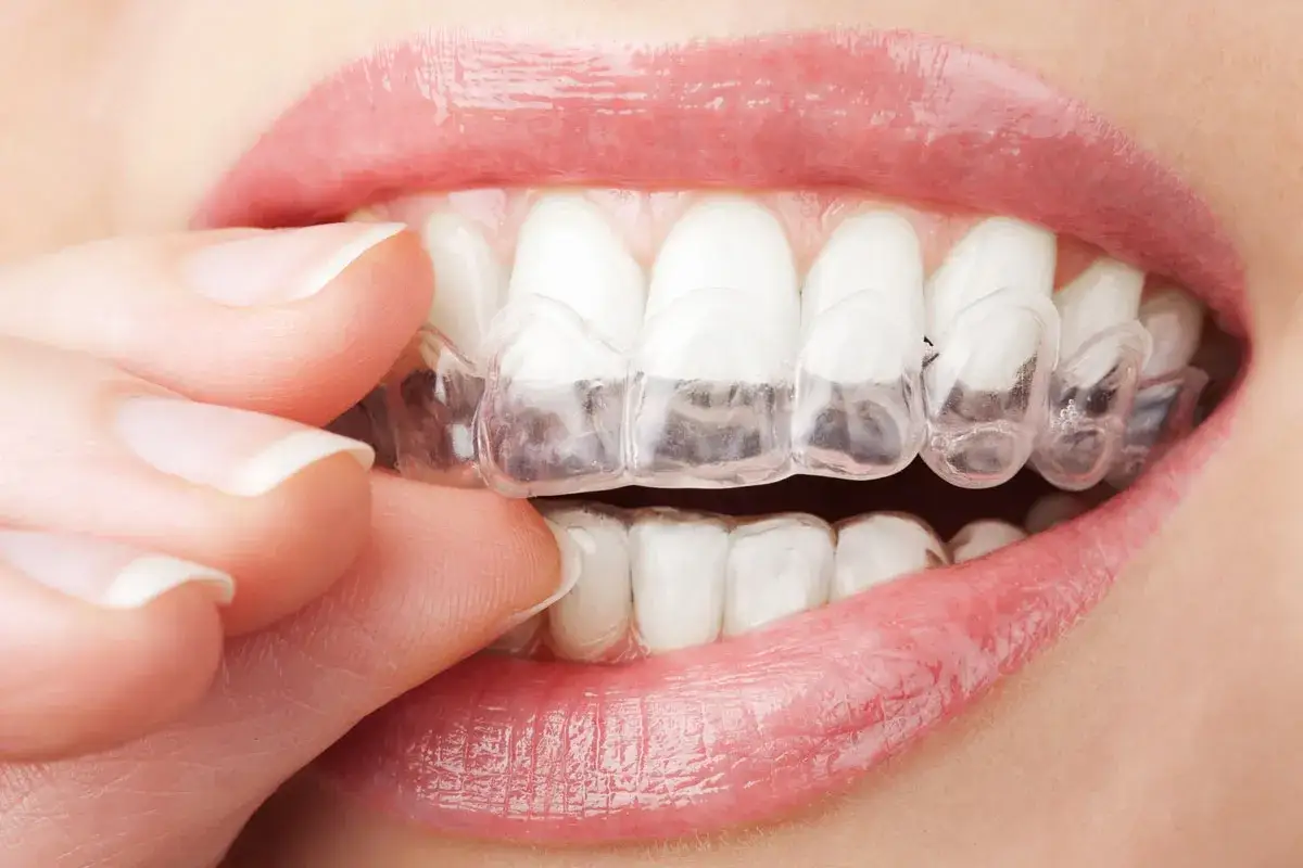 Dita che rimuovono un apparecchio mobile notturno trasparente dai denti bianchi.