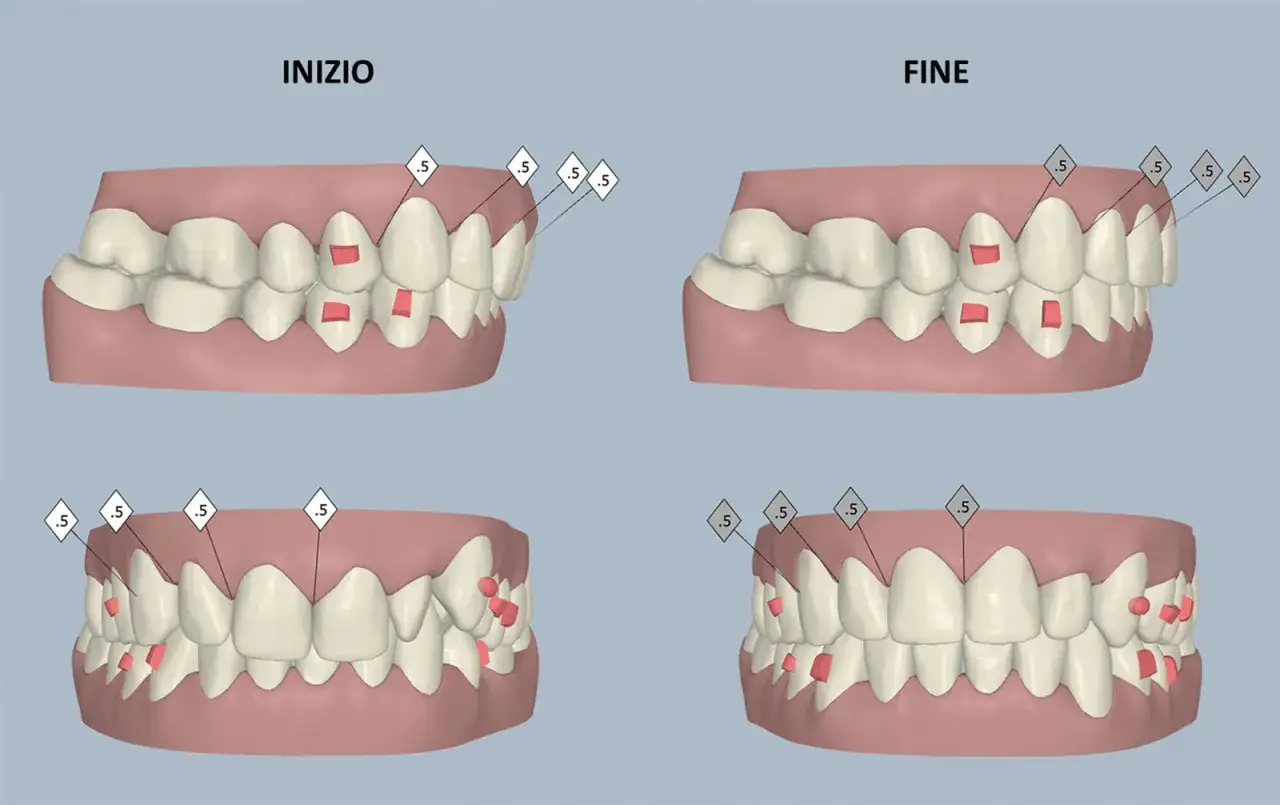 Modellazione 3D di un'occlusione dentale prima e dopo il trattamento ortodontico, con indicazioni di movimento.