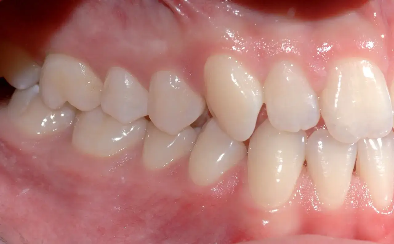 Denti allineati con una leggera malocclusione di classe 1, visibile nell'arcata inferiore.
