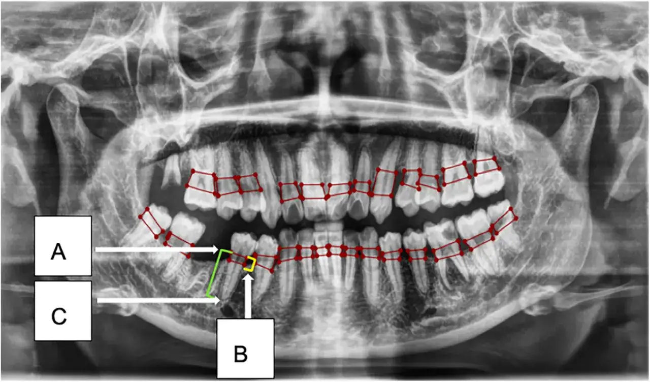 Radiografia panoramica dei denti con marcature rosse che evidenziano la struttura ossea degli alveoli dentali. Indicazioni A, B, C puntano a diverse aree.
