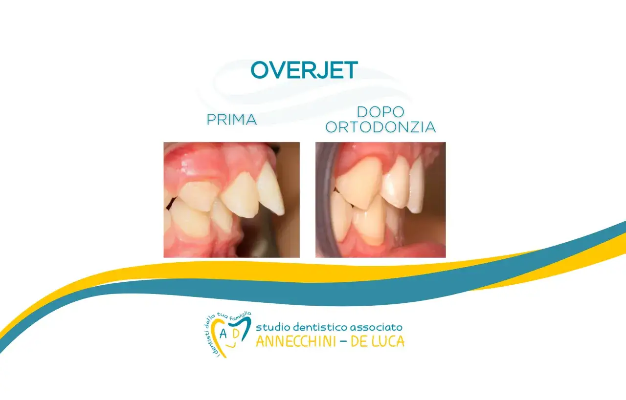Confronto prima e dopo ortodonzia per correggere overjet e overbite. Denti allineati e sorriso migliorato.
