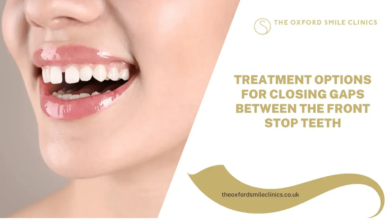 Primo piano di un sorriso con diastema, che illustra le opzioni di trattamento per chiudere gli spazi tra i denti anteriori.