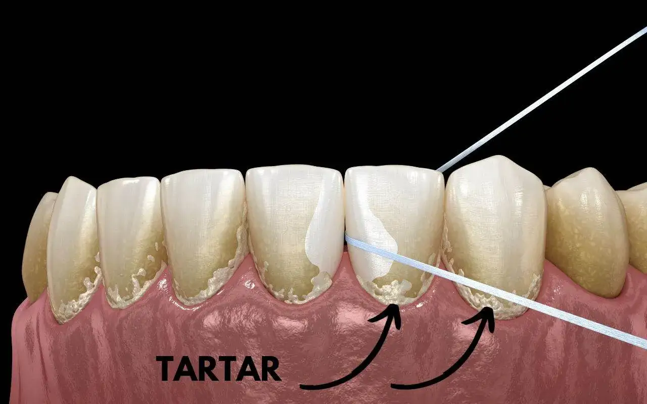 Denti con accumuli di tartaro visibile alla base. Il filo interdentale mostra la differenza tra placca e tartaro, evidenziando la necessità di pulizia.