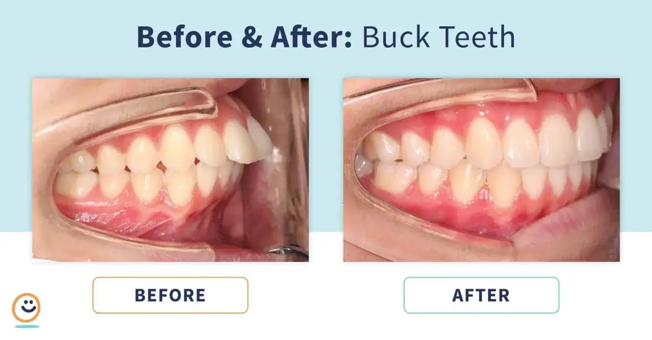 Prima e dopo: denti da coniglio corretti. L'immagine mostra un sorriso con denti sporgenti prima del trattamento e un sorriso allineato dopo.