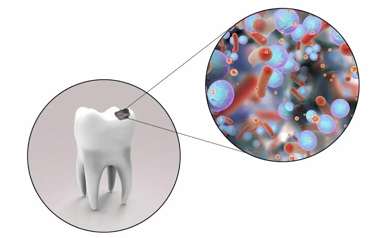 Dente con carie e ingrandimento di batteri che causano disbiosi orale.