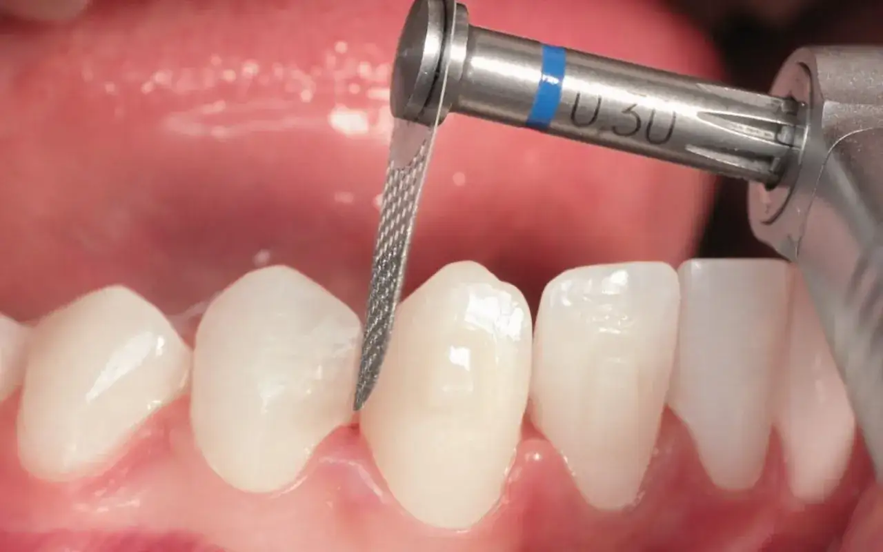Strumenti dentali lavorano sui denti. Attenzione alle controindicazioni per lo stripping denti.