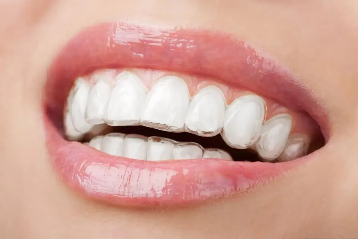 Sorriso impeccabile con un apparecchio invisibile che corregge delicatamente i denti.