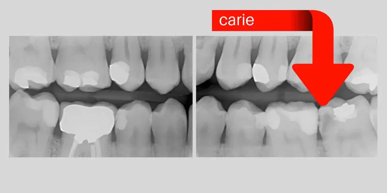 Radiografie dentali mostrano un dente bucato lateralmente, evidenziato da una freccia rossa e la parola 