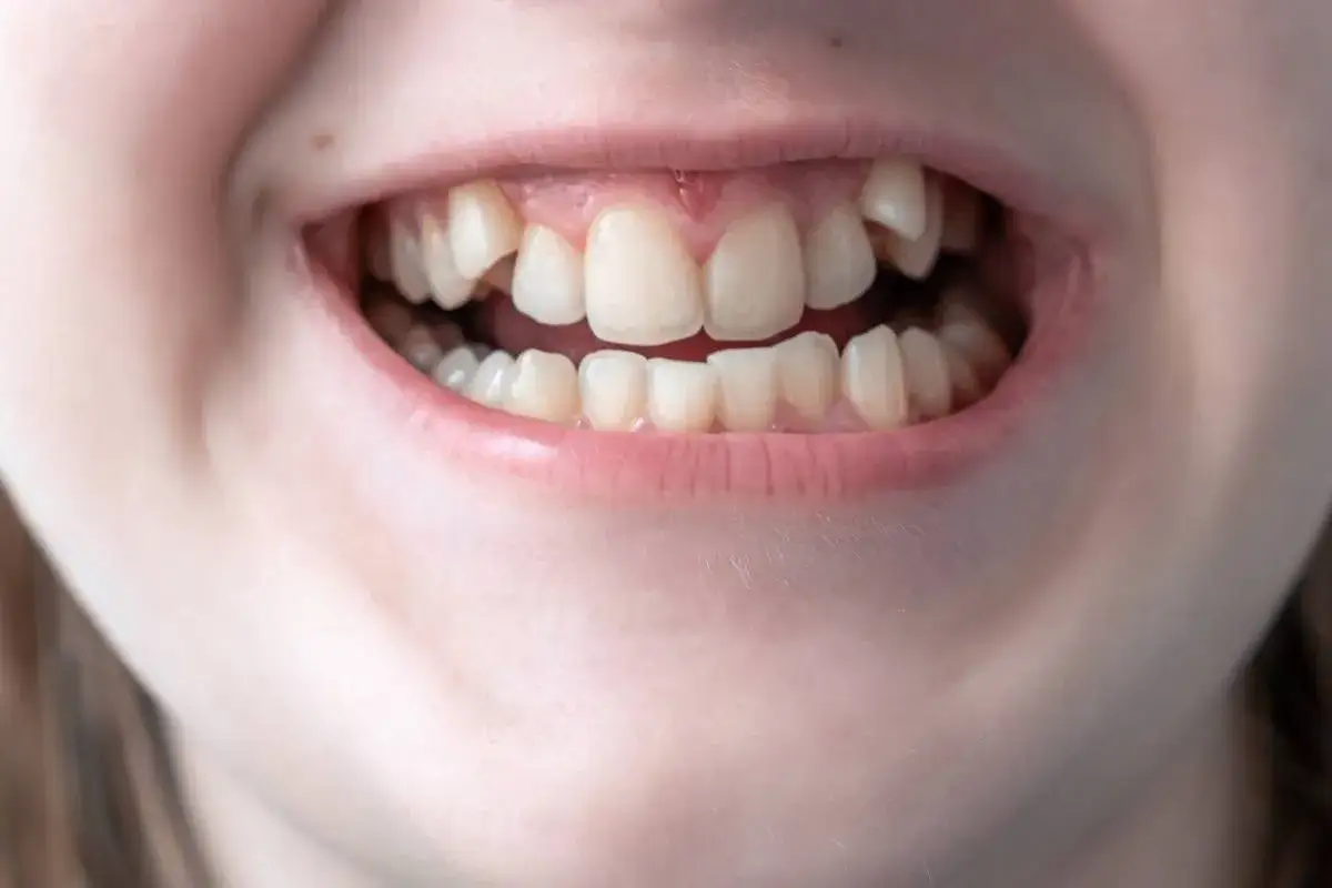 Un sorriso con un dente storto, un dettaglio che rende unico questo sorriso.
