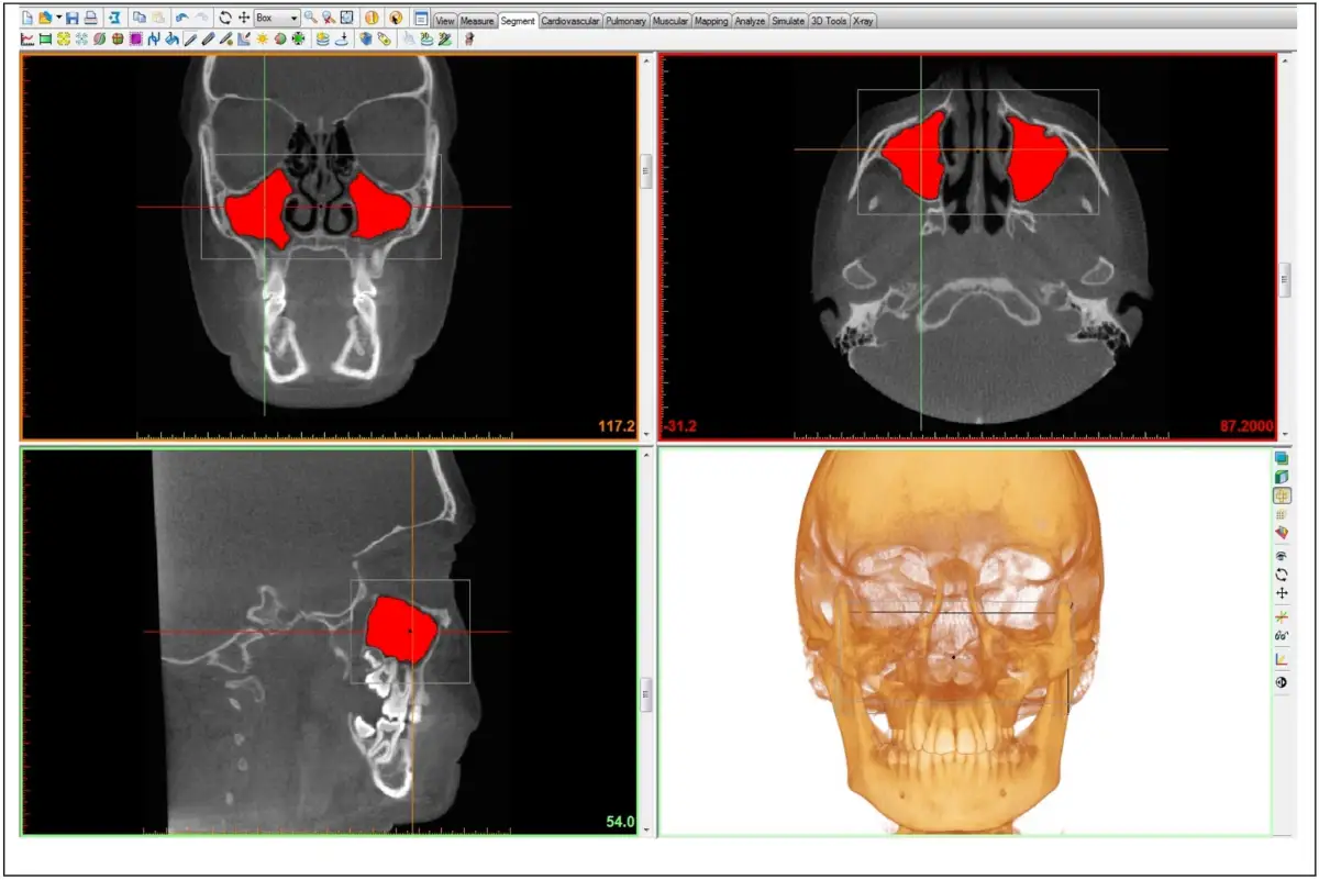 Scansione TC del cranio con evidenziato in rosso l'antro di Higmoro. Viste coronale, assiale, sagittale e ricostruzione 3D.