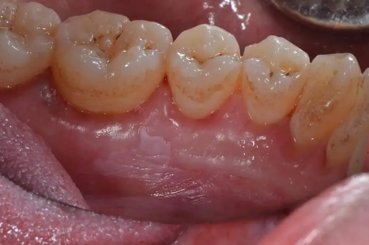 Dettaglio di denti con un piccolo puntino nero sul dente, gengive rosa e lingua.