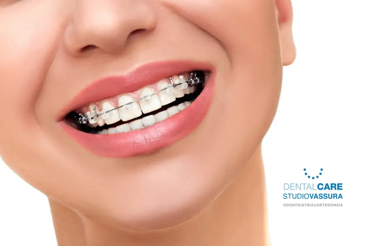 Sorriso smagliante con apparecchio fisso, denti bianchi e labbra rosa.