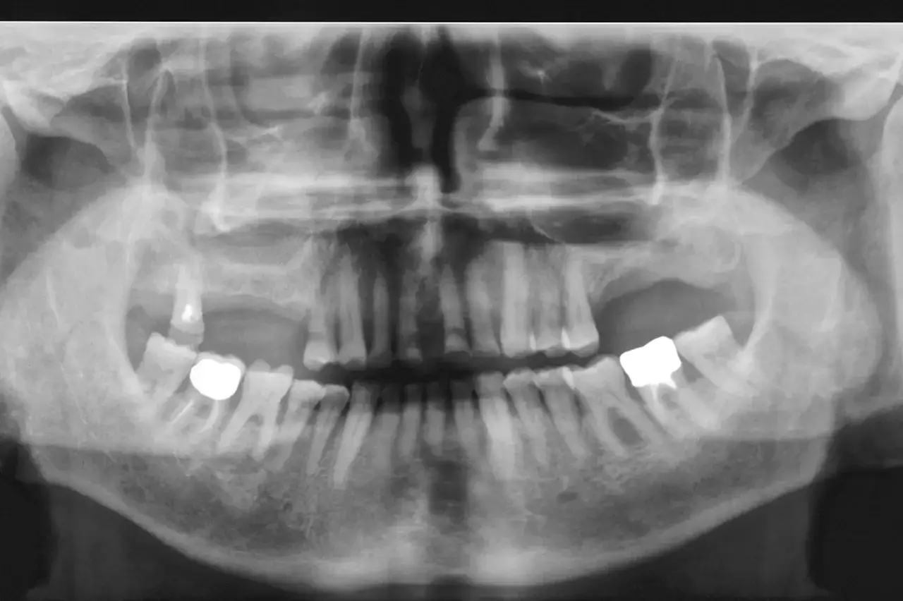 Radiografia panoramica dentale che mostra segni di sinusopatia mascellare, con opacit&agrave; nei seni mascellari e alterazioni dentali.