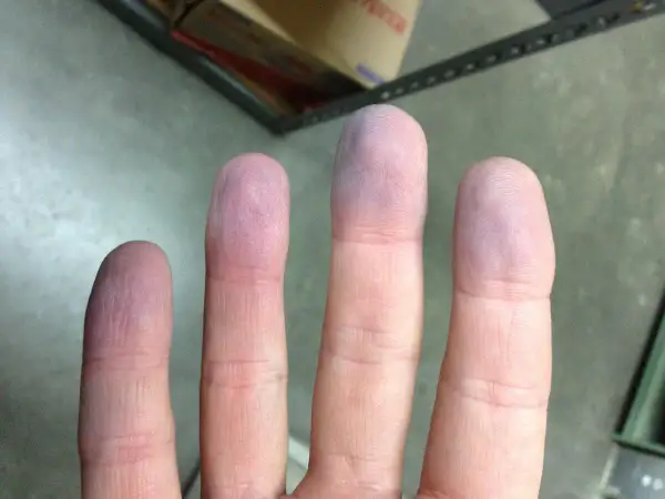 Dita con colorazione bluastra, possibili cause da indagare.