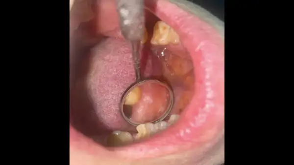 Area bianca sulla guancia interna, possibile leucoplachia. Esame dentistico in corso.