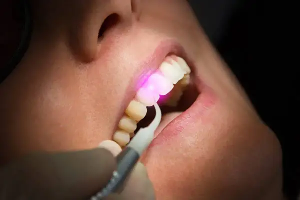 Trattamento dentale con laser. Un raggio rosa illumina un dente, mostrando la precisione della laser dentistry.