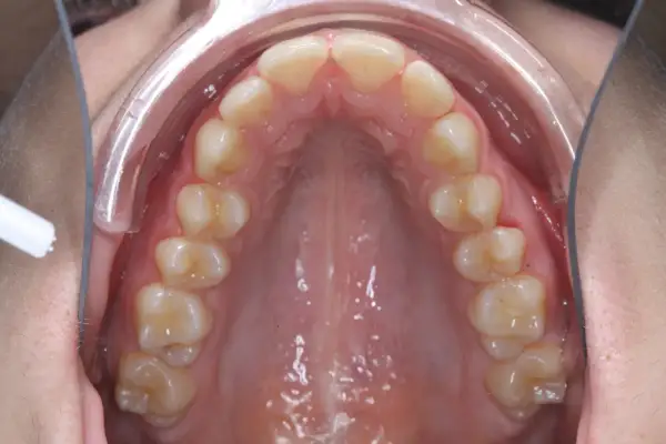 Vista interna della bocca con denti superiori e palato. Si nota un leggero mento retratto, con un divaricatore che espone l'arcata dentale.