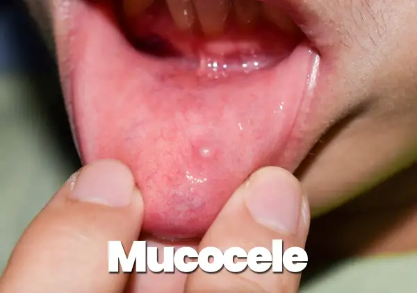 Piccolo mucocele, una cisti da ritenzione, appare sulla mucosa interna della bocca, evidenziata da dita.